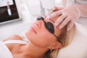 Epilation laser des sourcils
